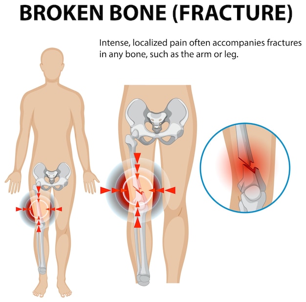 Illustration of a fractured bone