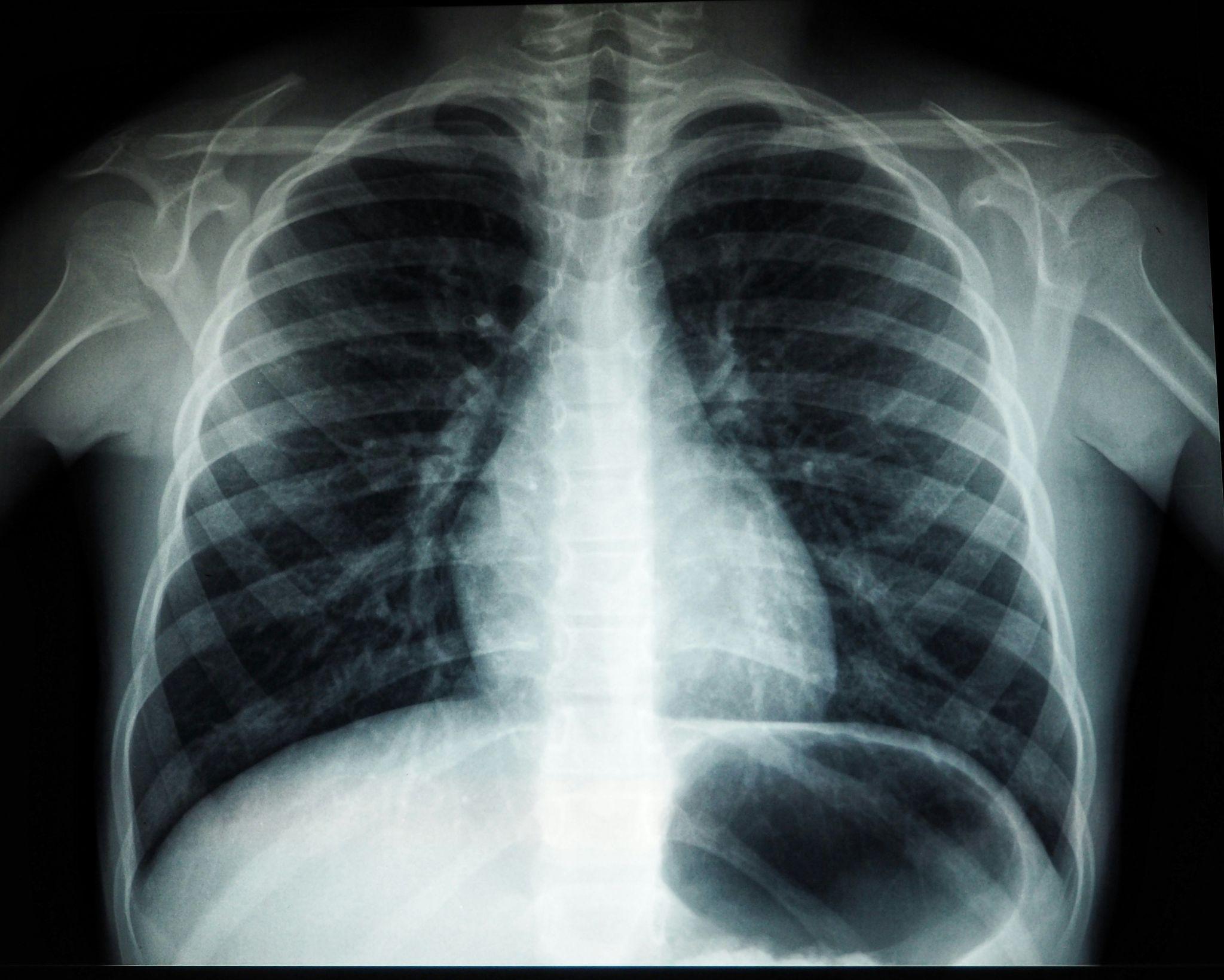 An X-ray image of human lungs showing the respiratory system.