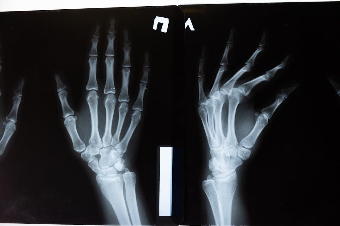 An X-ray of a hand