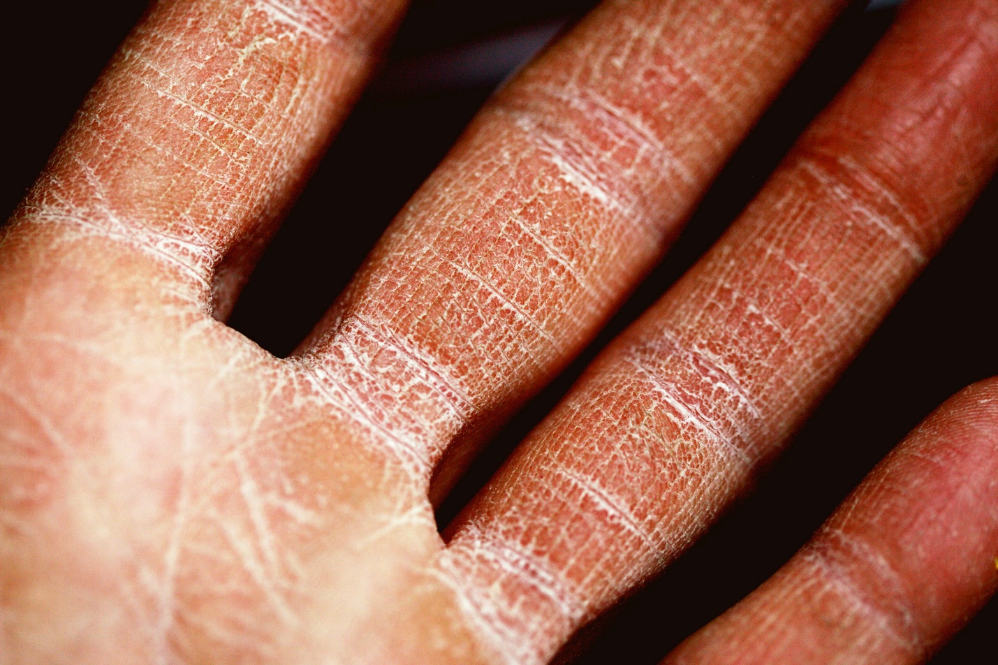 Close-up of dry, cracked skin on fingers associated with eczema flare-up