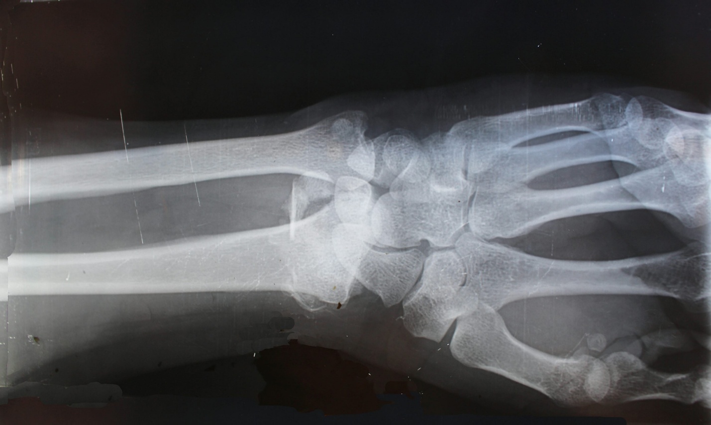 X-ray image of a wrist used to evaluate possible fracture versus sprain
